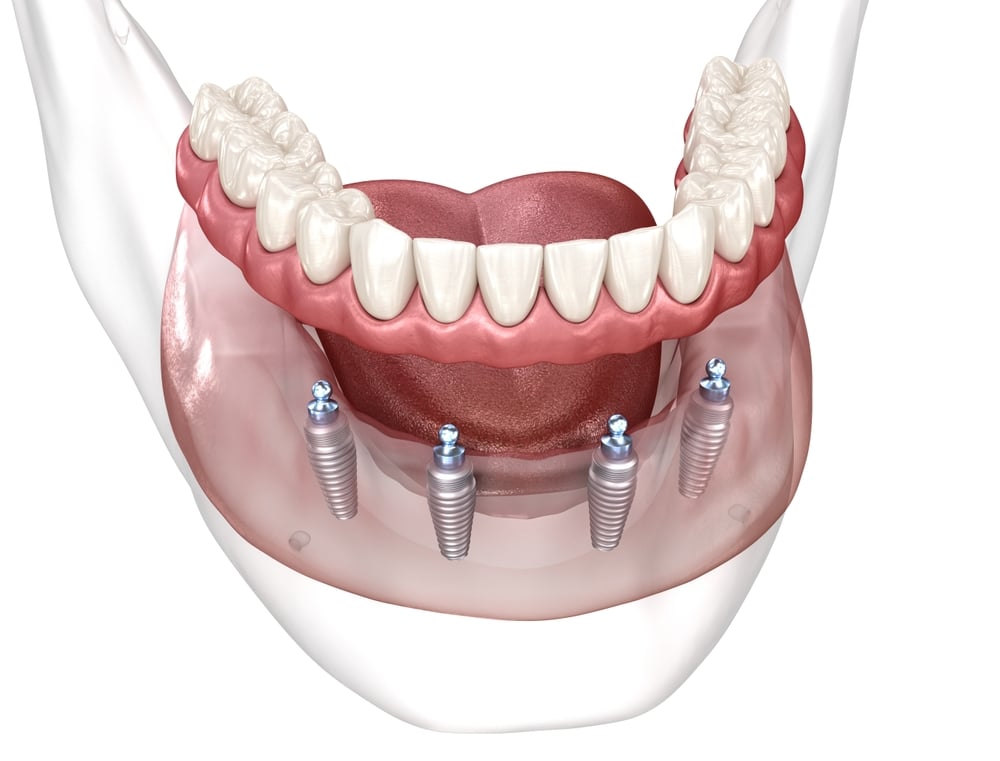 Dental,Prosthesis,Based,On,4,Implants.,Dental,3d,Illustration
