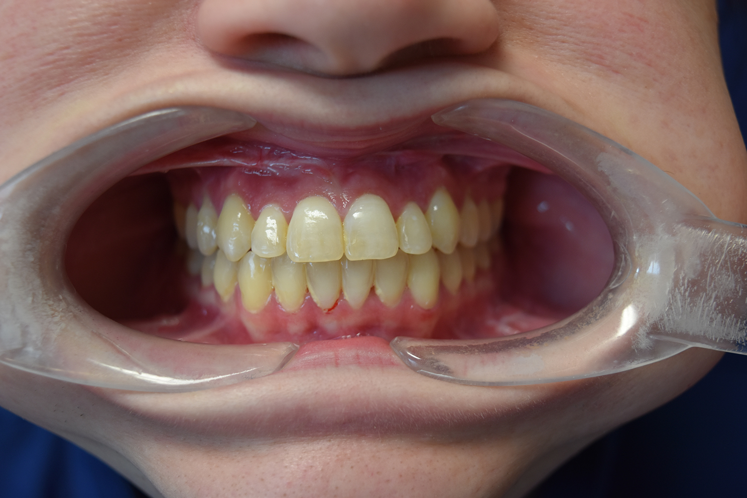 After Image: Reconstructive Jaw Surgery - front