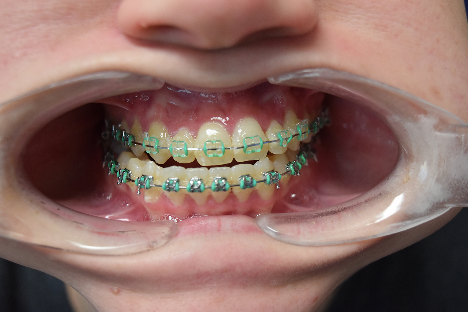 Before Image: Reconstructive Jaw Surgery - front