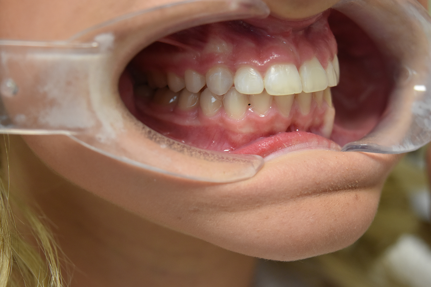 After Image: Reconstructive Jaw Surgery - right-front-oblique