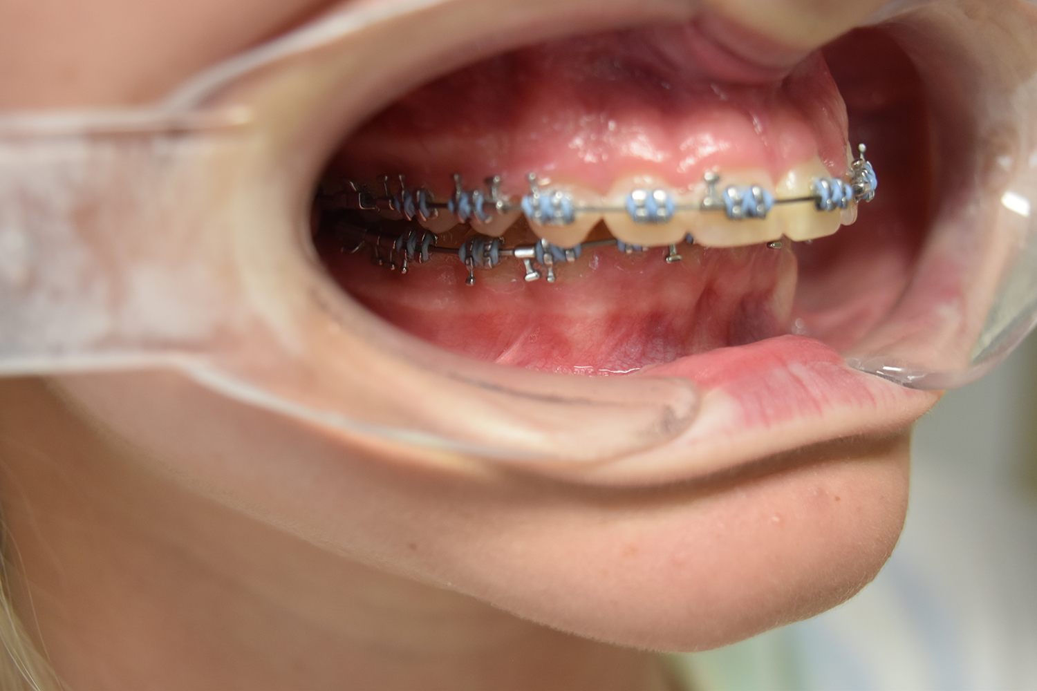 Before Image: Reconstructive Jaw Surgery - right-front-oblique