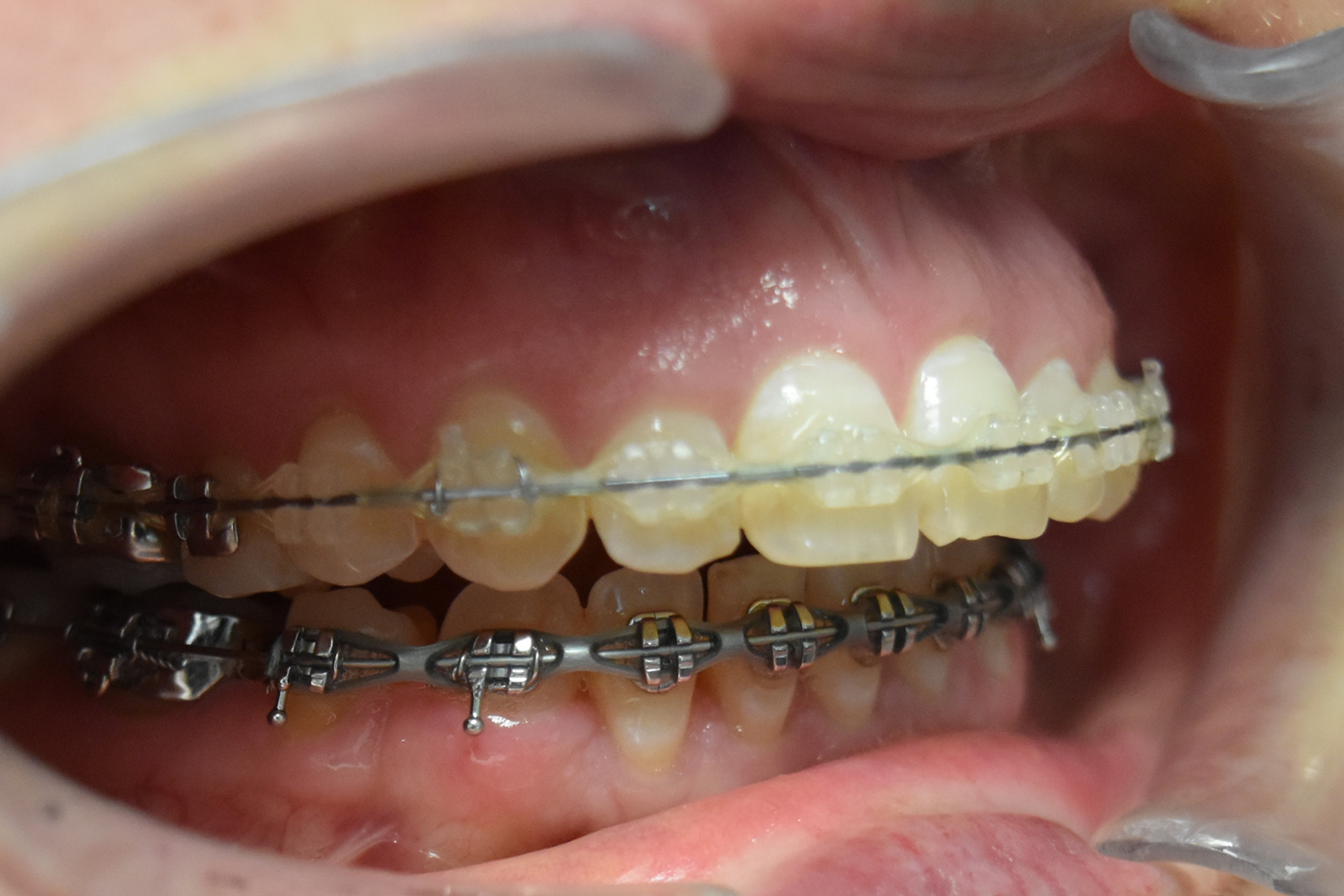 Before Image: Reconstructive Jaw Surgery - right-front-oblique