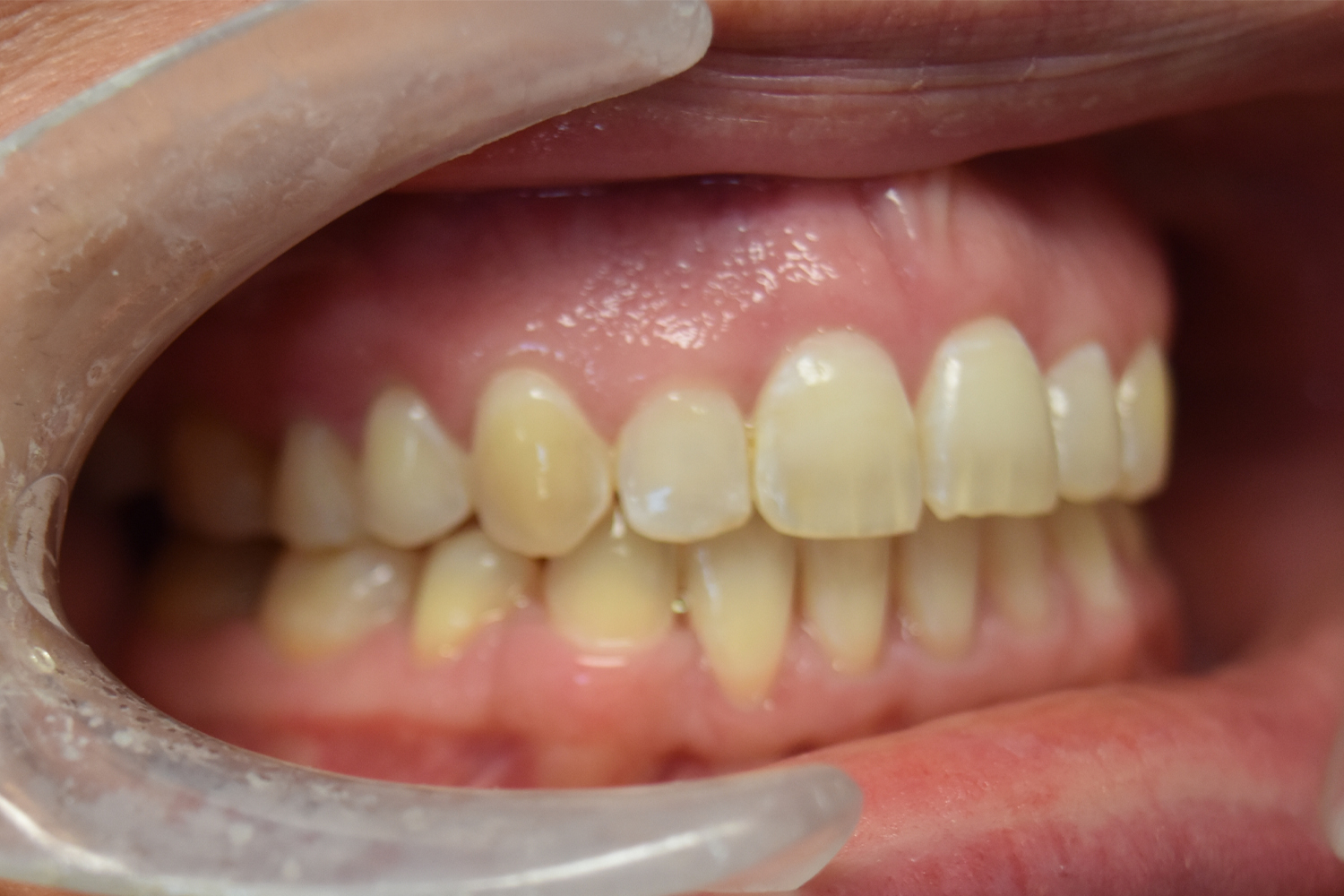 After Image: Reconstructive Jaw Surgery - right-front-oblique