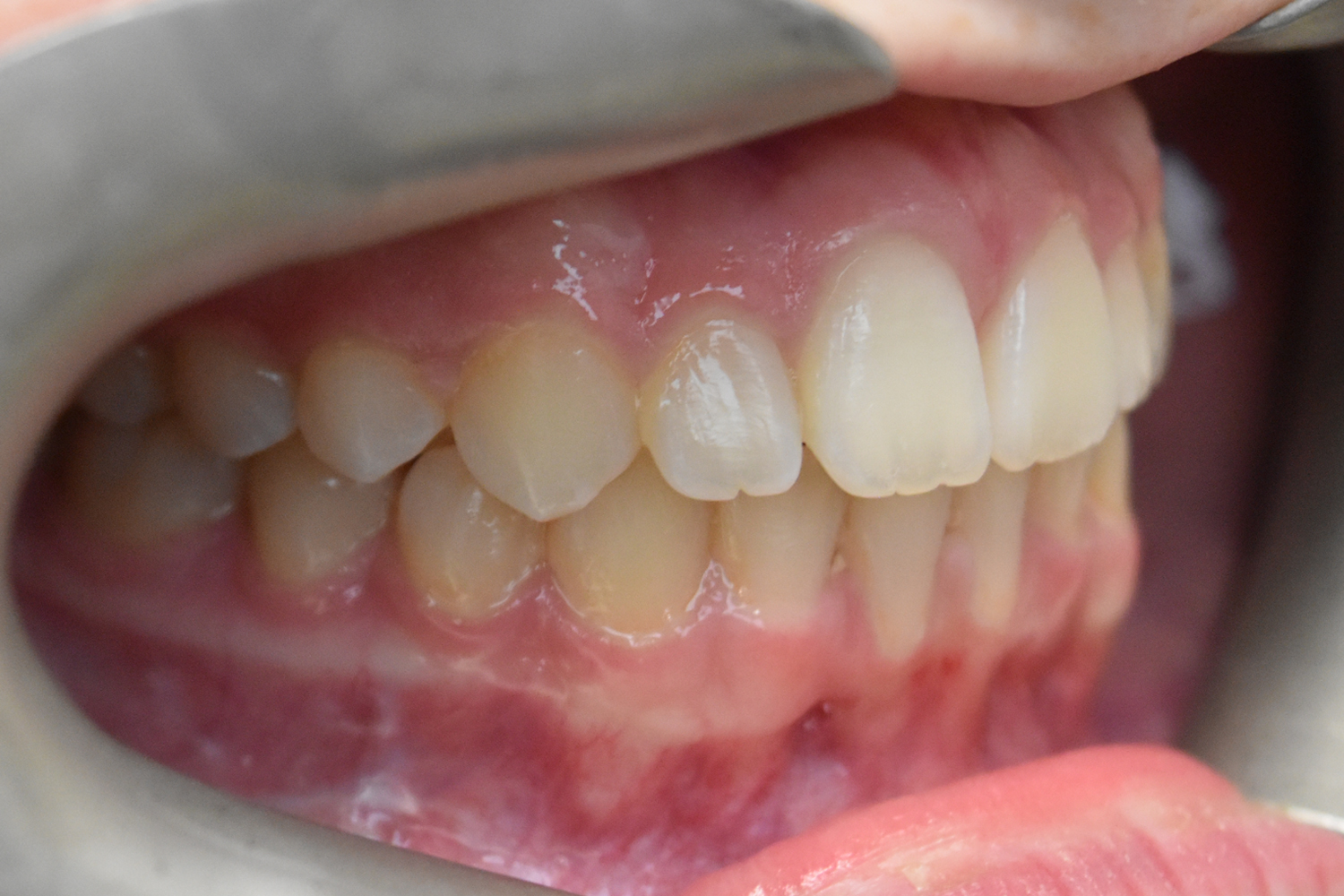 After Image: Reconstructive Jaw Surgery - right-front-oblique