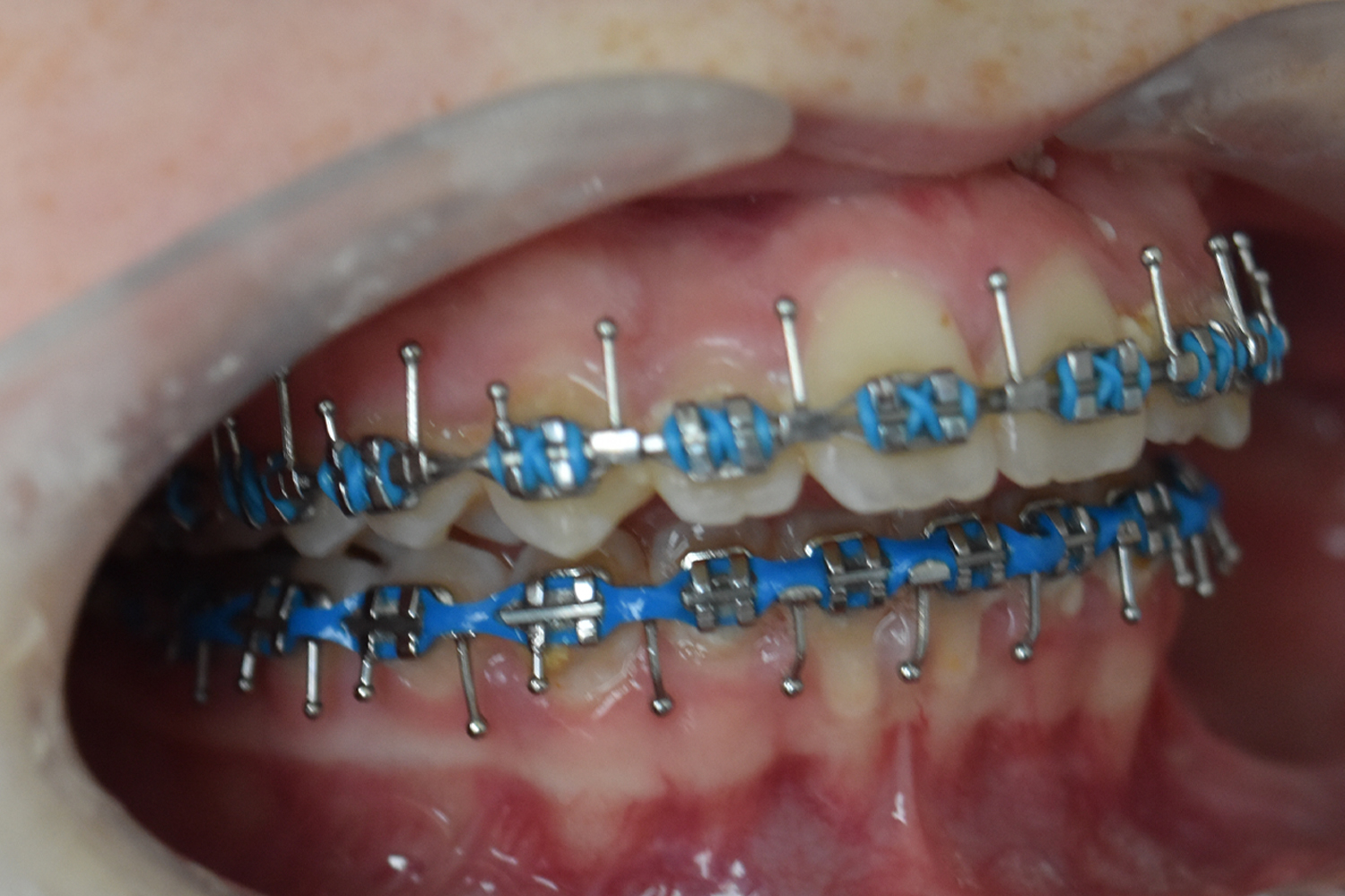 Before Image: Reconstructive Jaw Surgery - right-front-oblique