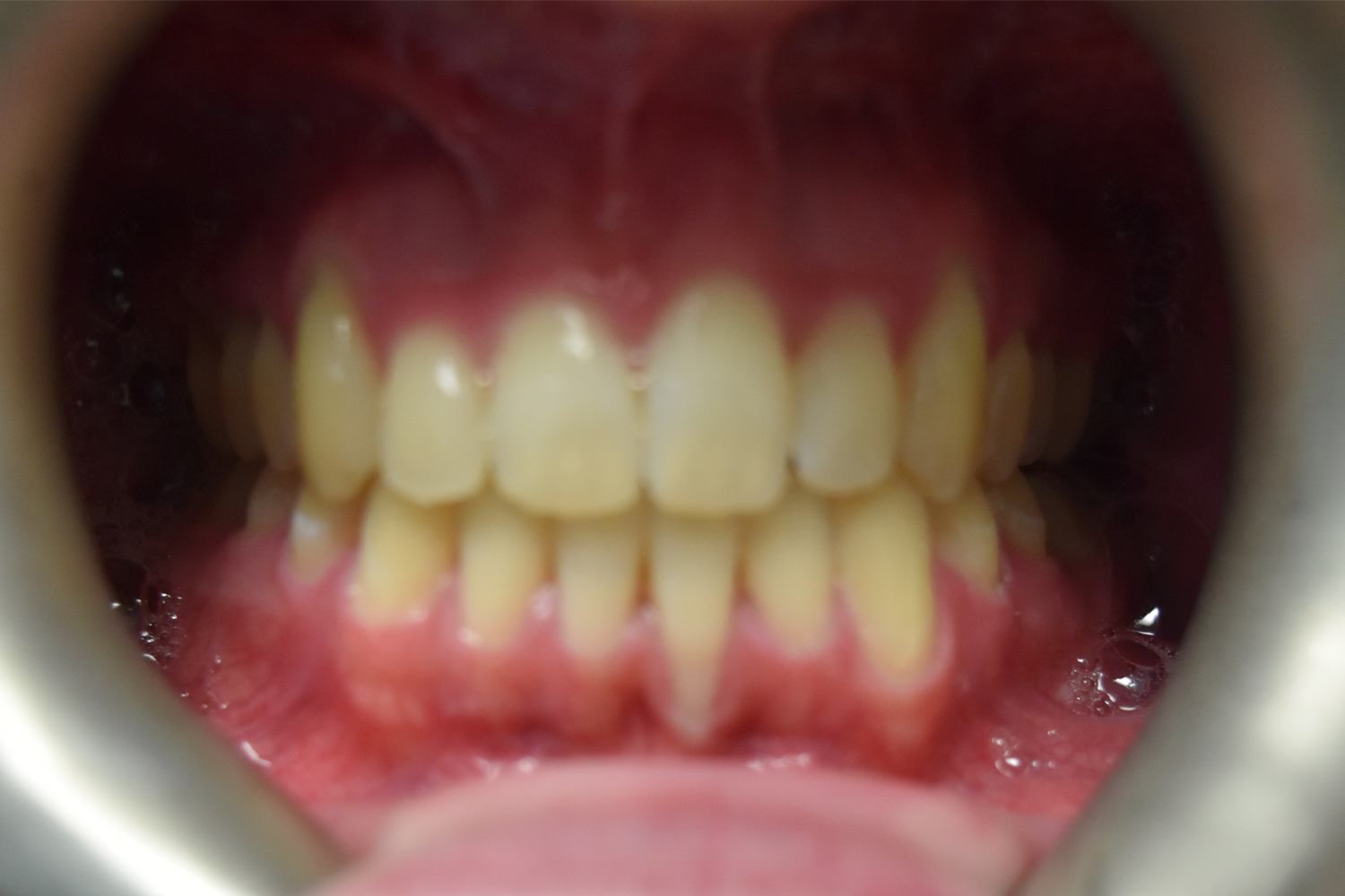 After Image: Reconstructive Jaw Surgery - front