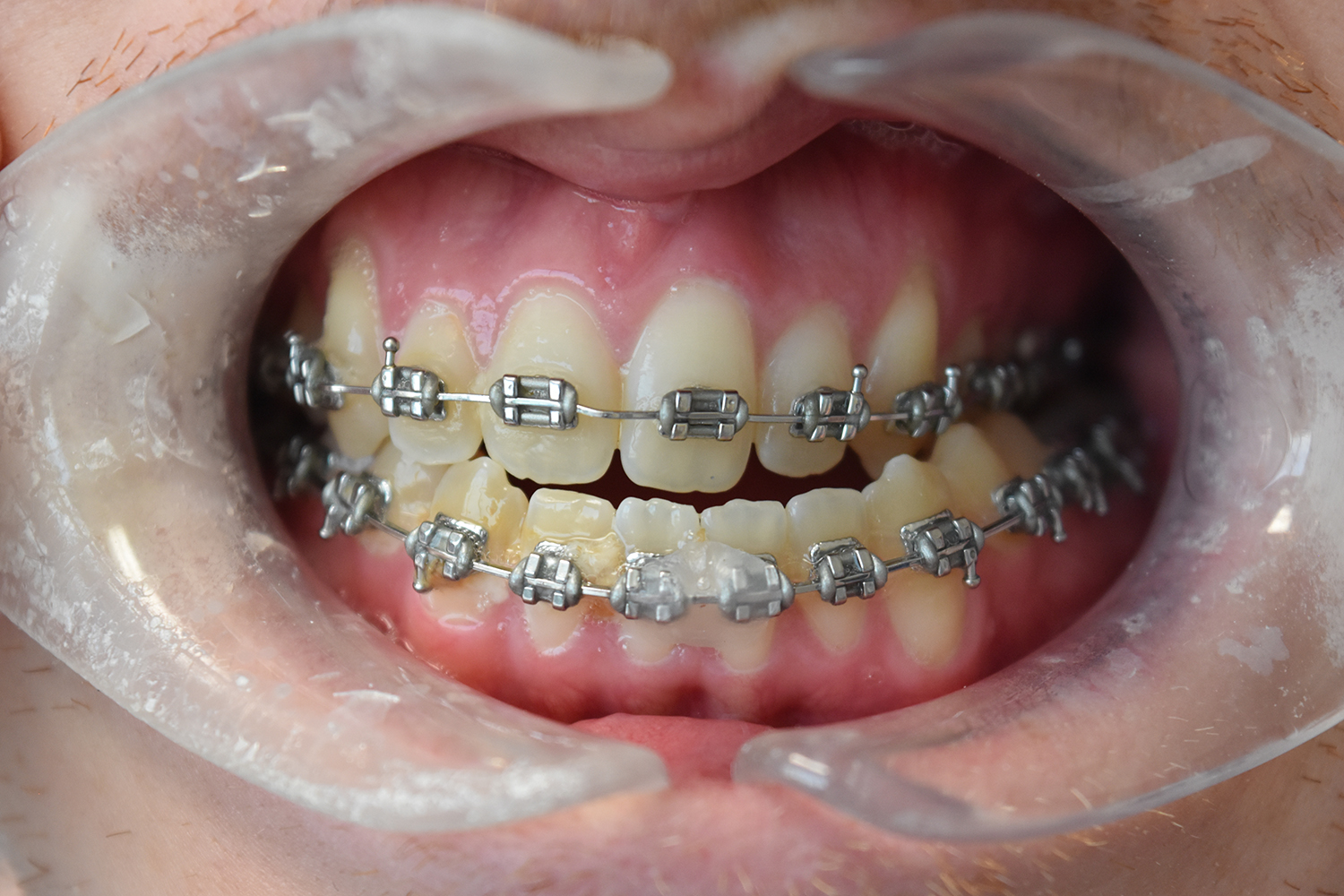 Before Image: Reconstructive Jaw Surgery - front