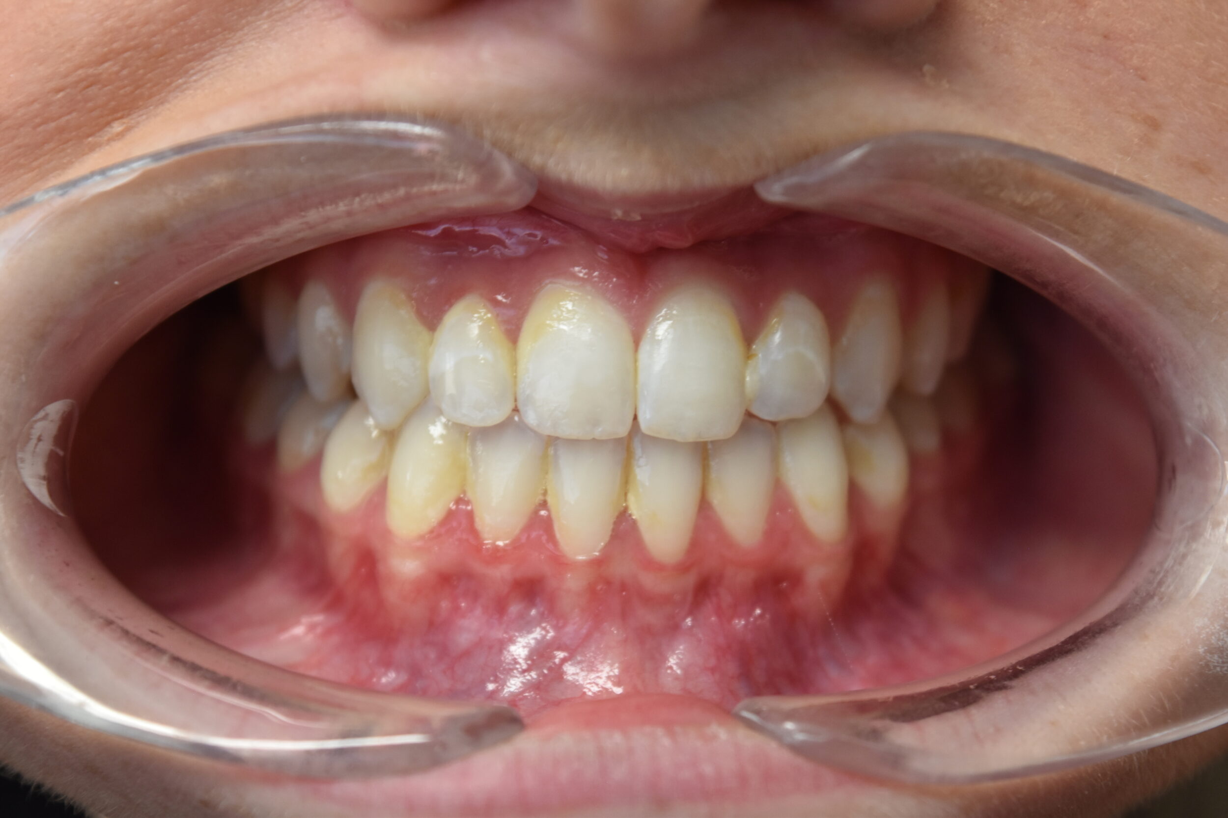 After Image: Reconstructive Jaw Surgery - front