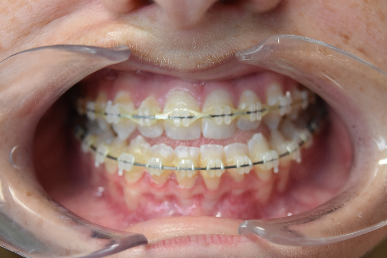 Before Image: Reconstructive Jaw Surgery - front