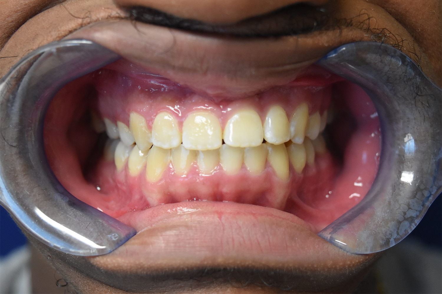 After Image: Reconstructive Jaw Surgery - front