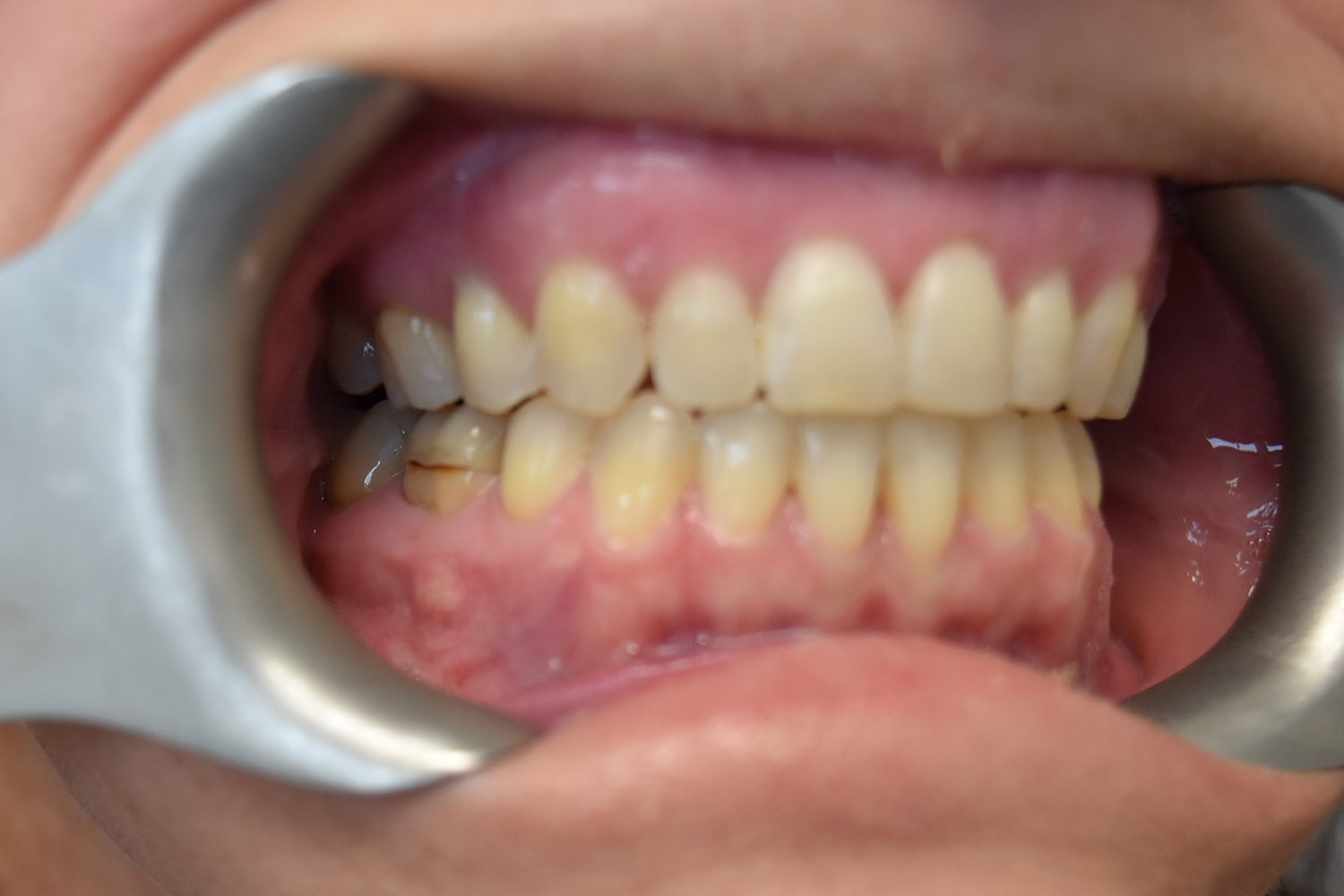 After Image: Reconstructive Jaw Surgery - right-front-oblique