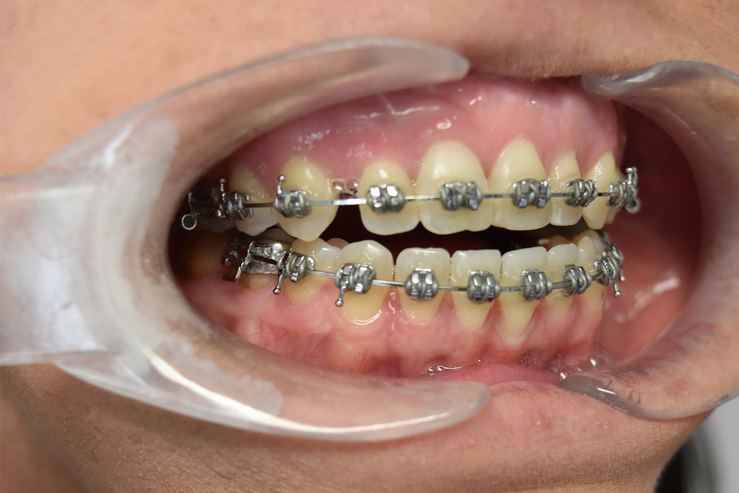 Before Image: Reconstructive Jaw Surgery - right-front-oblique