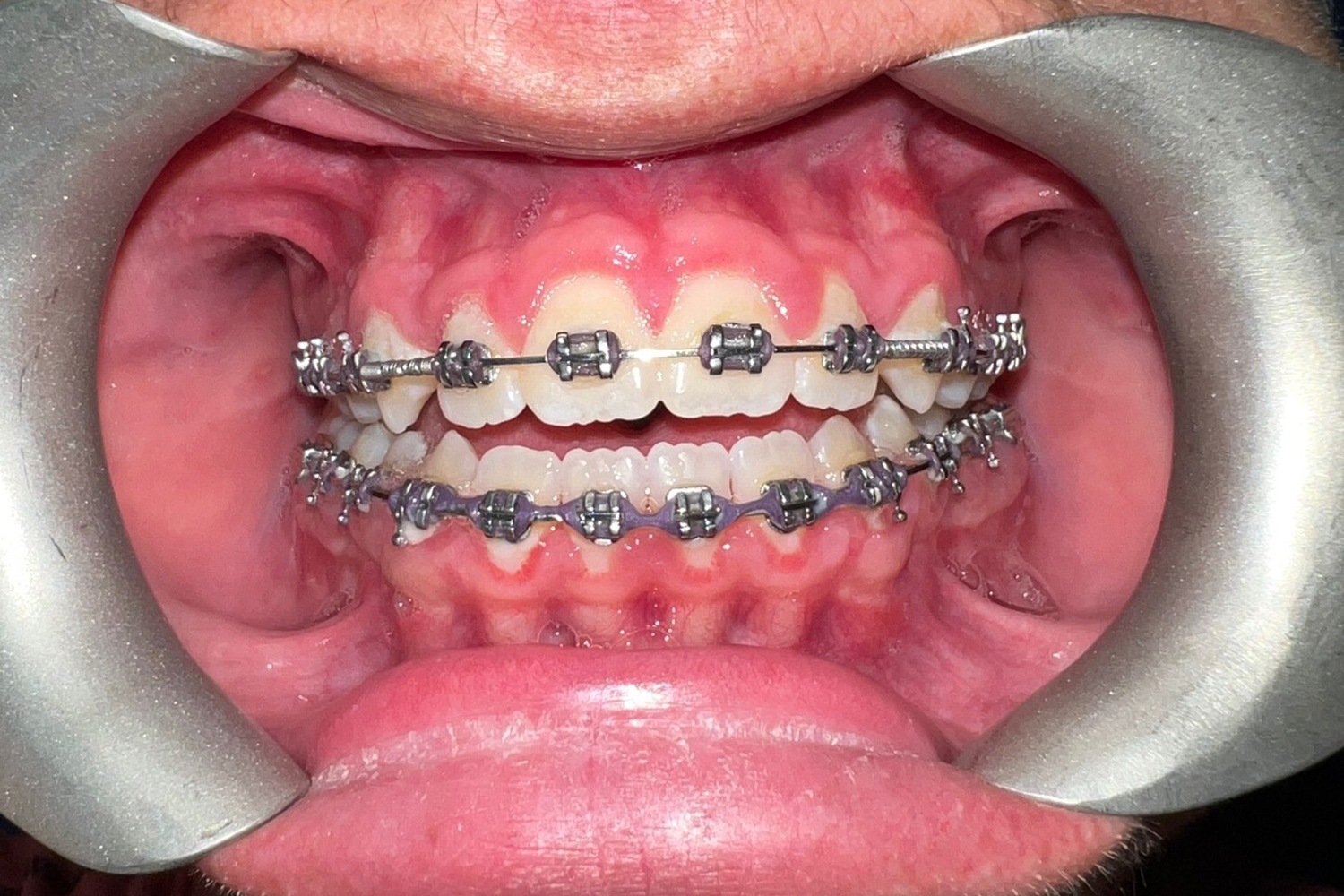 Before Image: Reconstructive Jaw Surgery - front