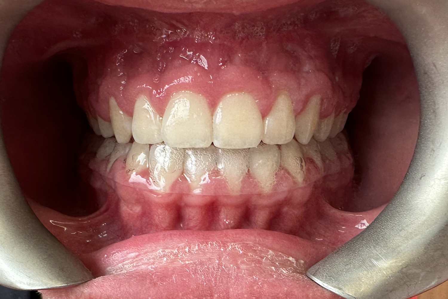 After Image: Reconstructive Jaw Surgery - front